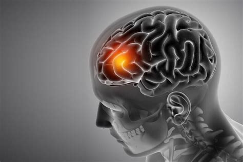 Image result for Aphasia Language Disorder