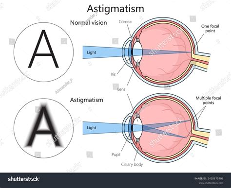 Astigmatism Disorder Medical Structure Diagram Hand Stock Illustration 2428875793 | Shutterstock