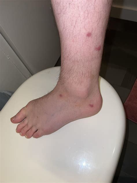 Do these look like bed bug bites? : r/bugbite