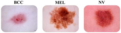 Skin Cancer Diagnosis Using VGG16 and Transfer Learning: Analyzing the ...