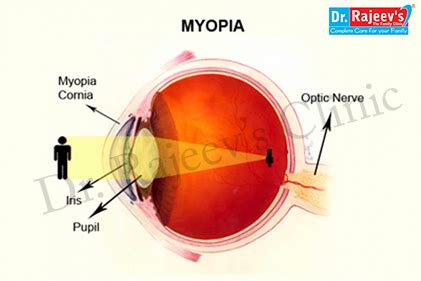 homeopathic treatment for Myopia in homeopathy, Myopia Treatment in ...