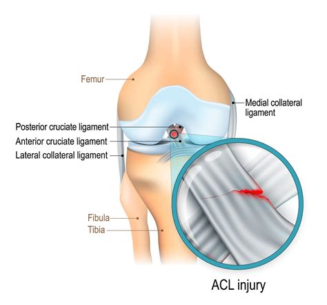 ACL Tears - Link Health & Fitness
