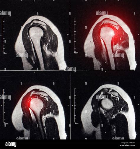 Imagerie IRM de l'articulation de l'épaule après fracture et luxation. Fracture d'empreinte de ...