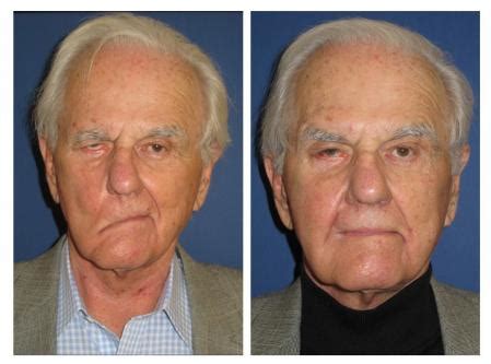 Facial Paralysis Treatment Bells Palsy Treatment ENT S - Delhi - Click.in