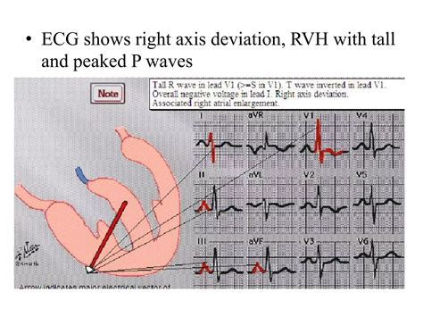 Congenital heart diseases.pptx