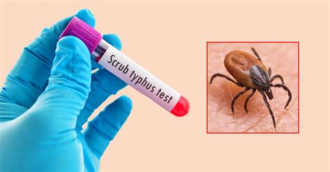 Scrub-Typhus-34.jpg