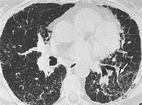 Hypersensitivity Pneumonitis | AJR