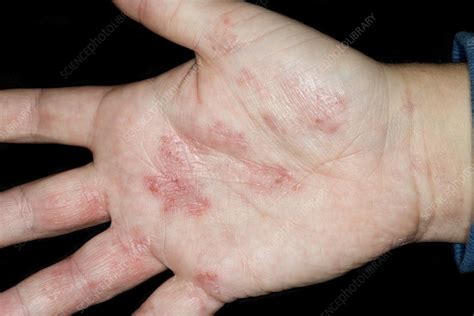 Eczema on the palm - Stock Image - C021/3303 - Science Photo Library