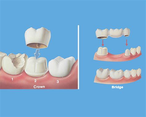 Dental Crowns in Madinaguda | Dental Bridges in Madinaguda | Capital ...