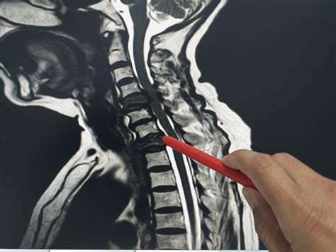 Spinal Tumors Specialist - Orange, CA: Dr. S. Samuel Bederman: Orthopedic Spine Surgeon