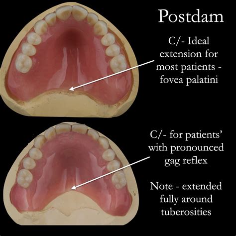 Palatal Reflex Vs Gag Reflex at Katie Jenkins blog