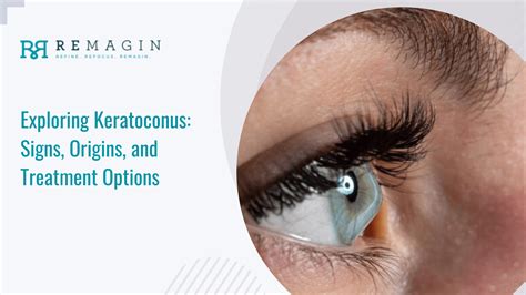 Understanding Keratoconus: Symptoms, Causes, and Treatment Strategies