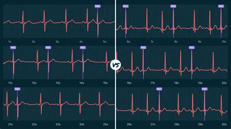 Atrial Bigeminy Vs. Atrial Trigeminy on Your Watch ECG | Qaly
