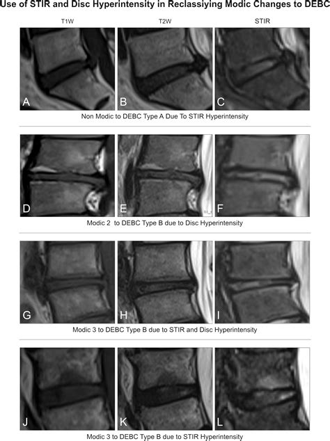 The disc-endplate-bone-marrow complex classification: progress in our understanding of Modic ...