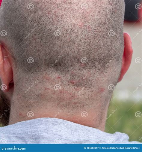 Back of the Head of a Short Haired Man Suffering from Scalp Acne Problem Stock Image - Image of ...