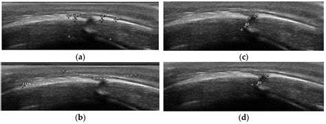Predictive Value of Sonographic Parameters on the Effects of Cranial ...