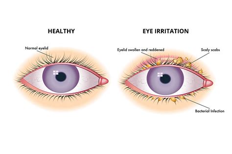 Common Therapies for Blepharitis and Other Eyelid Irritation - PRN ...