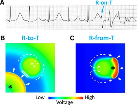 Cardiac Alternans: From Bedside to Bench and Back | Circulation Research
