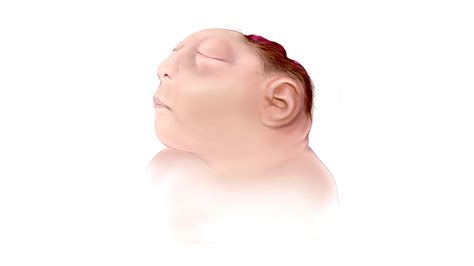 Babies With Hydranencephaly