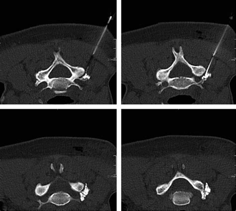 Image result for Selective Nerve Root Block C6