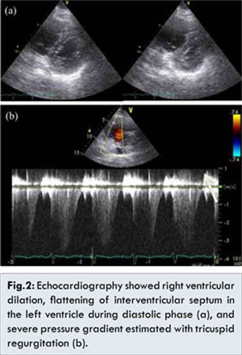 Pulmonary Tumor Thrombotic Microangiopathy by Lung Adenocarcinoma