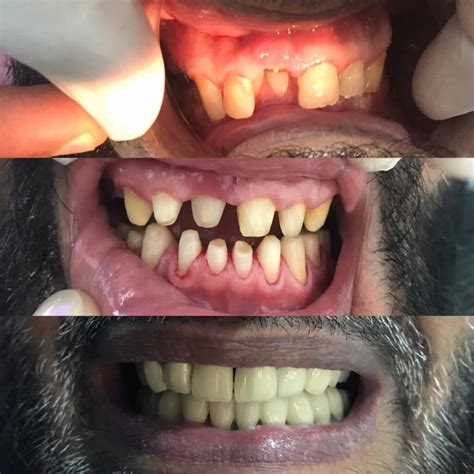 Full mouth bridge | Behzad Ali Khan | Prosthocontest2019