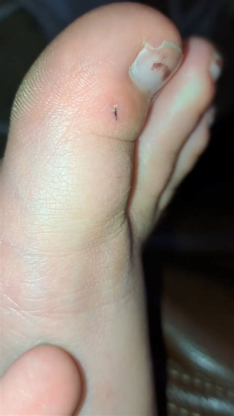 Image result for Toe Bro Splinter
