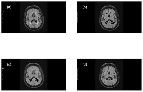 Training Artificial Neural Networks to Detect Multiple Sclerosis ...