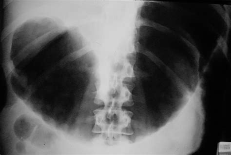 Ulcerative Colitis | Surgery Photos