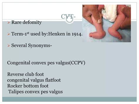 Congenital vertical talus BY DR.NAVEEN RATHOR | PPTX