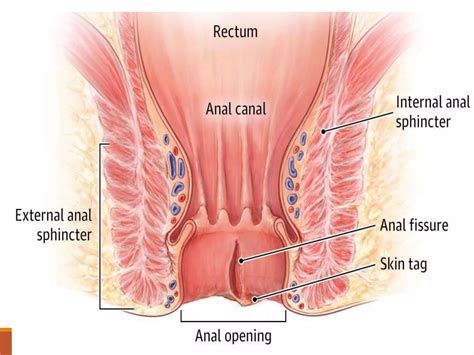 AnoRectal fissure,Abscess &fistula | PPTX