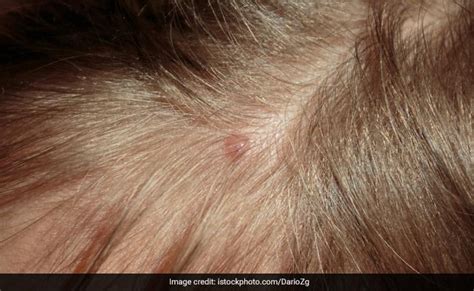 Hair Care: स्कैल्प में होने वाले पिंपल्स ने कर दिया है सिर का हाल बुरा ...