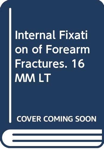 Buy Internal Fixation of Forearm Fractures. 16 MM LT Book Online at Low ...