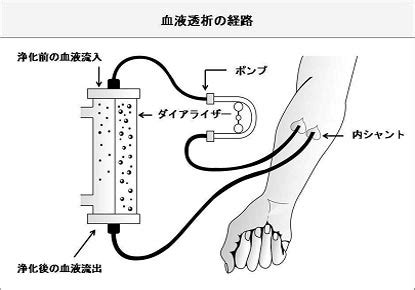 透析 | Dialysis - Complete Information about Dialysis and its types in ...
