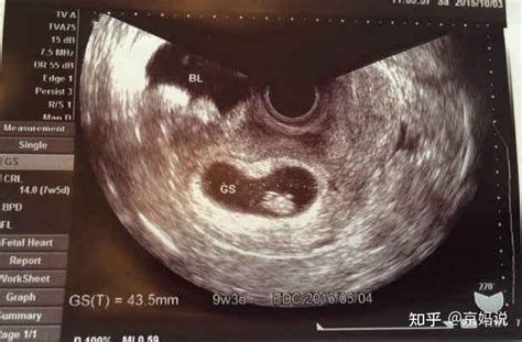 怀孕多久能看到胎芽胎心？ - 知乎