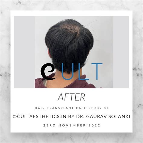 Hair Transplant Case Study 87 | Cult Aesthetics