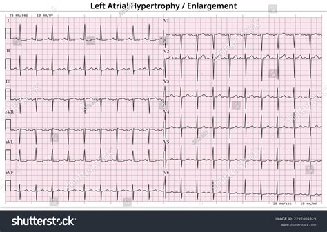 Ecg Left Atrial Hypertrophy Lvh Left Stock Vector (Royalty Free) 2292464929 | Shutterstock