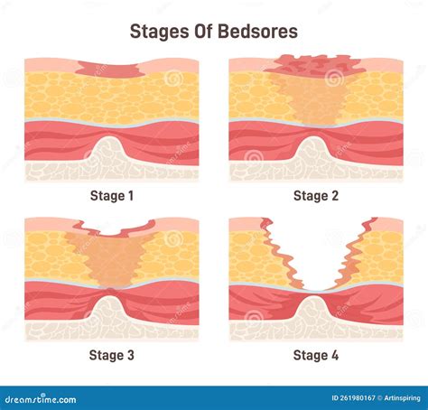 Bedsore Stages Set. Pressure Sores Areas on Human Body Parts Stock ...