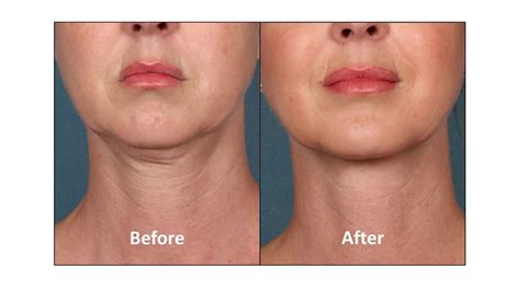 Image result for Chin Botox