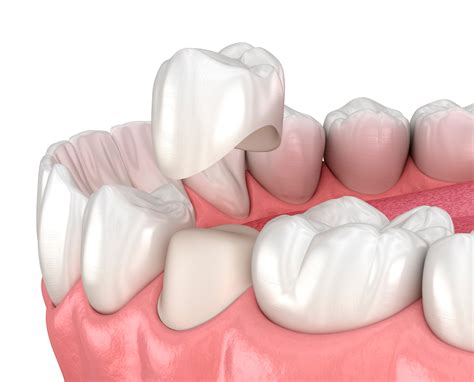 Restorative Dental Care