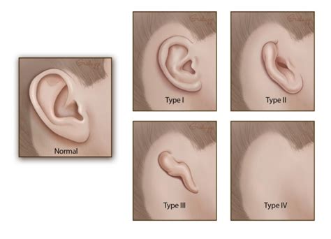 Microtia
