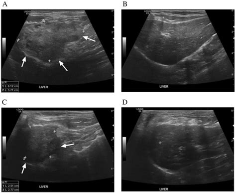 Feline Cyst-like Lymphocytic Cholangiohepatitis in a Cat: First Case Report