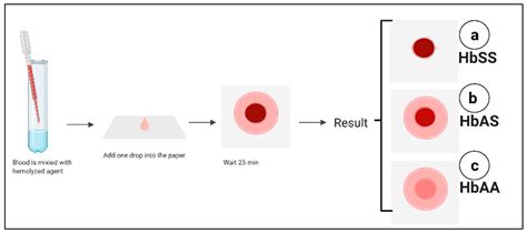 Sickle Cell Test What Is Sickle Cell Disease? Vitrosens