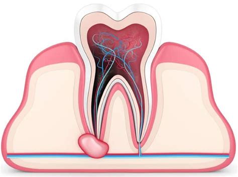 Popping Abscess Tooth 的图像结果