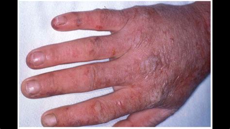 Health implications of climate crisis in India