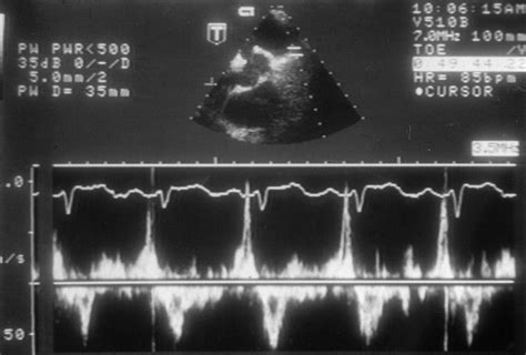 Left atrial appendage: structure, function, and role in thromboembolism | Heart