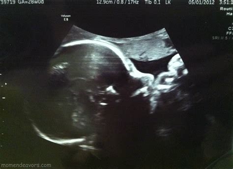 28 Weeks Ultrasound