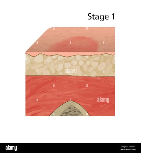 Pictures Of Bed Sores Stage 1 at Marco Linder blog