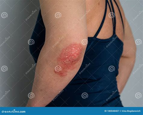 Psoriasis on Elbow. Isolated. Closeup of Rash and Scaling on the Patient`s Skin. the Concept of ...