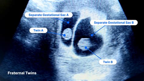 Twins Ultrasound 9 Weeks